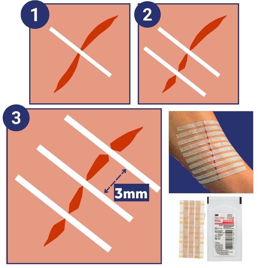 steristrip application