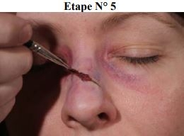 Maquillage secourisme fracture du nez étape 5