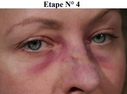 Maquillage secourisme fracture du nez étape 4