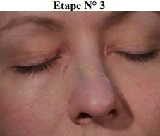 Maquillage secourisme fracture du nez étape 3