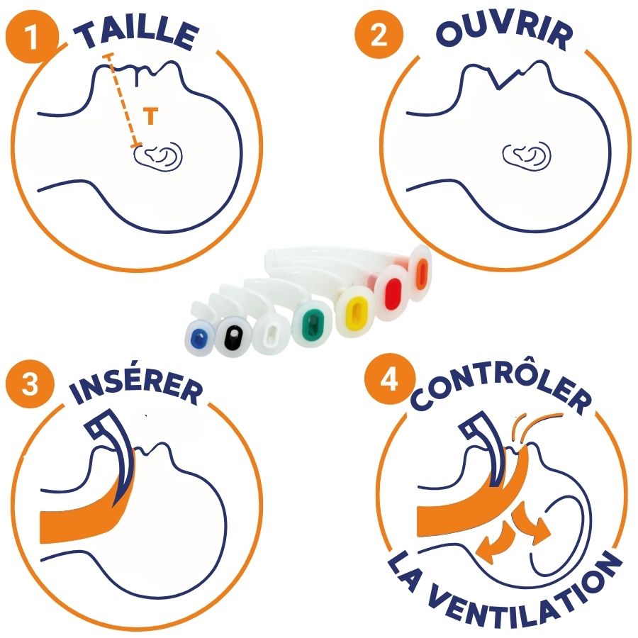 comment mettre une canule de guedel​