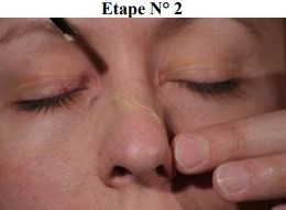 Maquillage secourisme fracture du nez étape 2